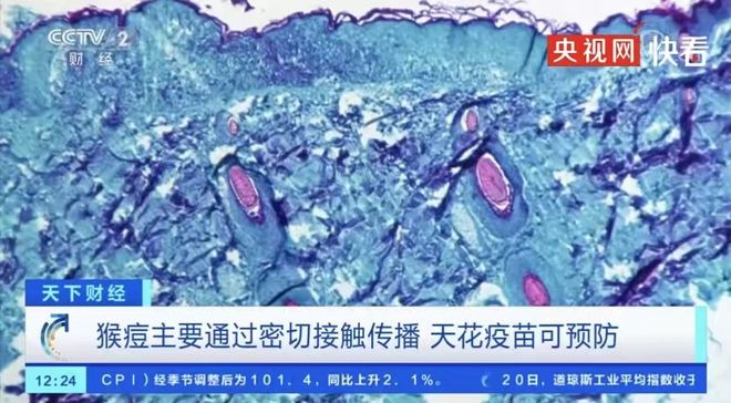 新冠未平猴痘又起!多国爆发猴痘疫情,这些问题要知道